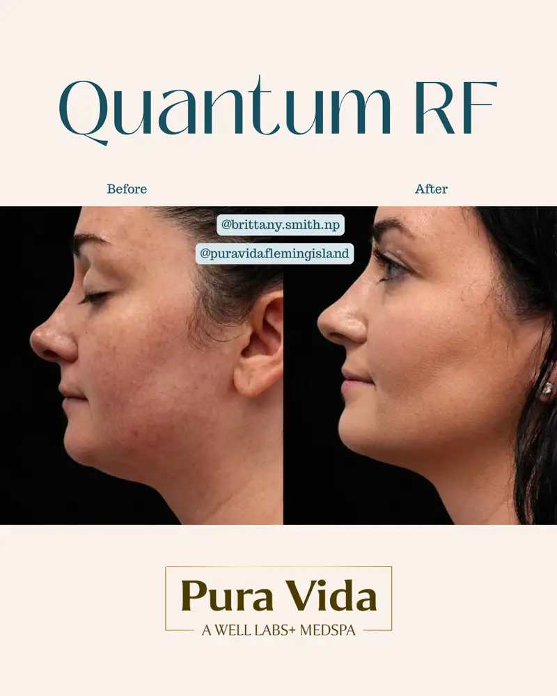 Before and after Quantum RF showing a smoother, more lifted lower face and jawline