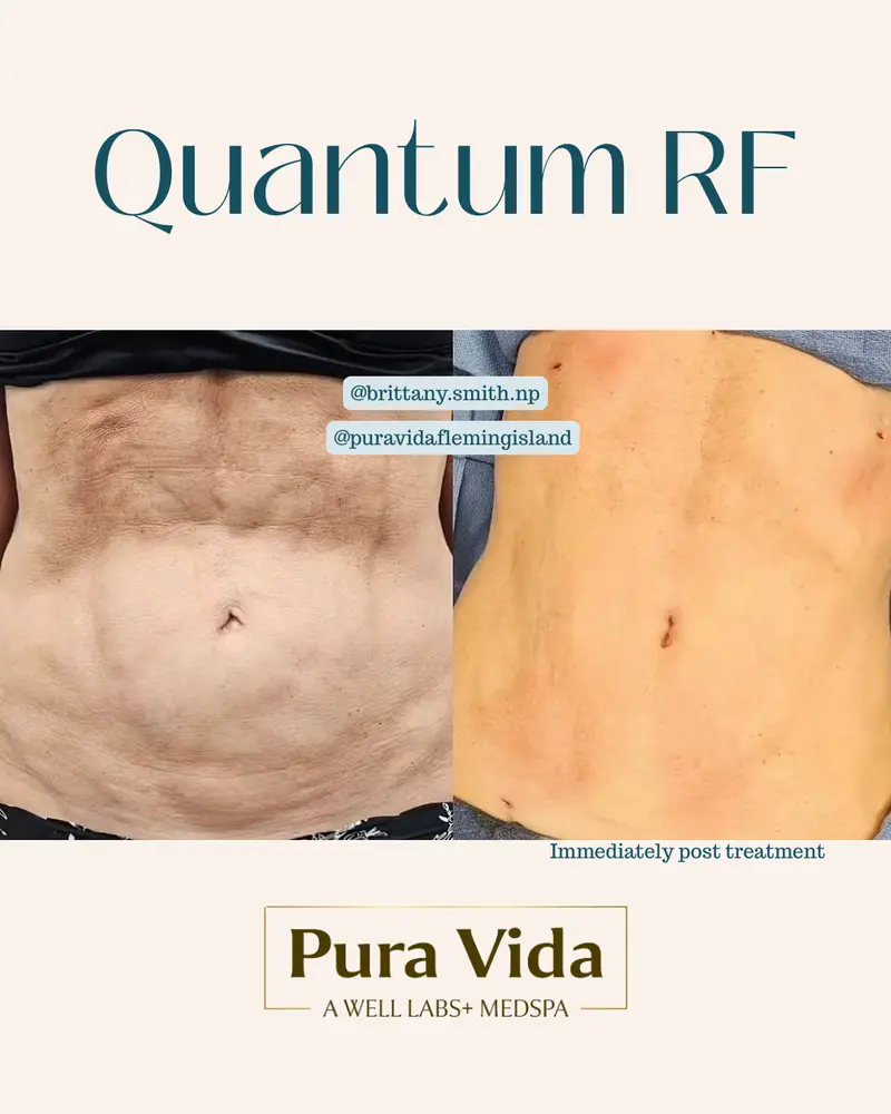 Before and after Quantum RF showing a tighter, smoother abdomen