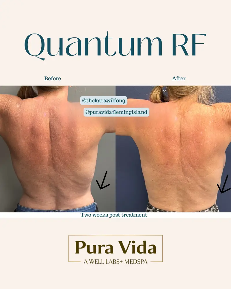Before and after Quantum RF showing firmer skin across the back two weeks post treatment