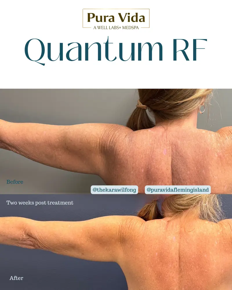 Before and after Quantum RF showing tighter skin on the arms and upper back two weeks post treatment