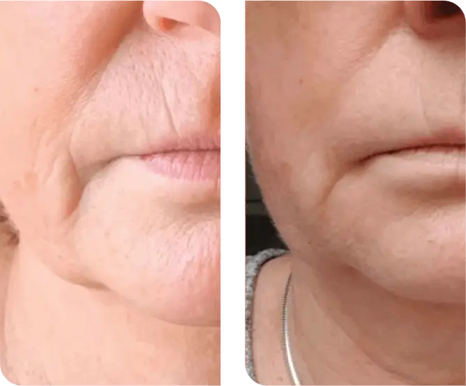 Before and after SaltFacial showing smoother, more refined skin around the mouth and jaw
