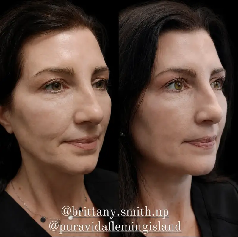 Before and after Sculptra showing restored cheek and temple volume from a three-quarter view