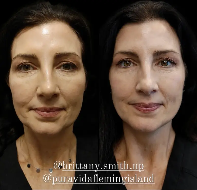 Before and after Sculptra showing a fuller midface and softer nasolabial folds from the front
