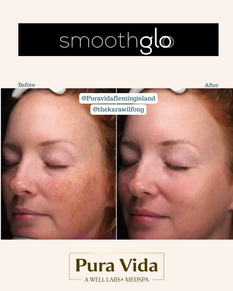 Before and after SmoothGlo showing lighter freckling and more even skin tone across the cheek