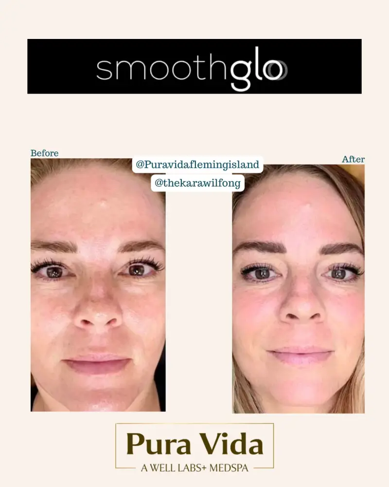 Before and after SmoothGlo showing calmer facial redness and a brighter overall complexion