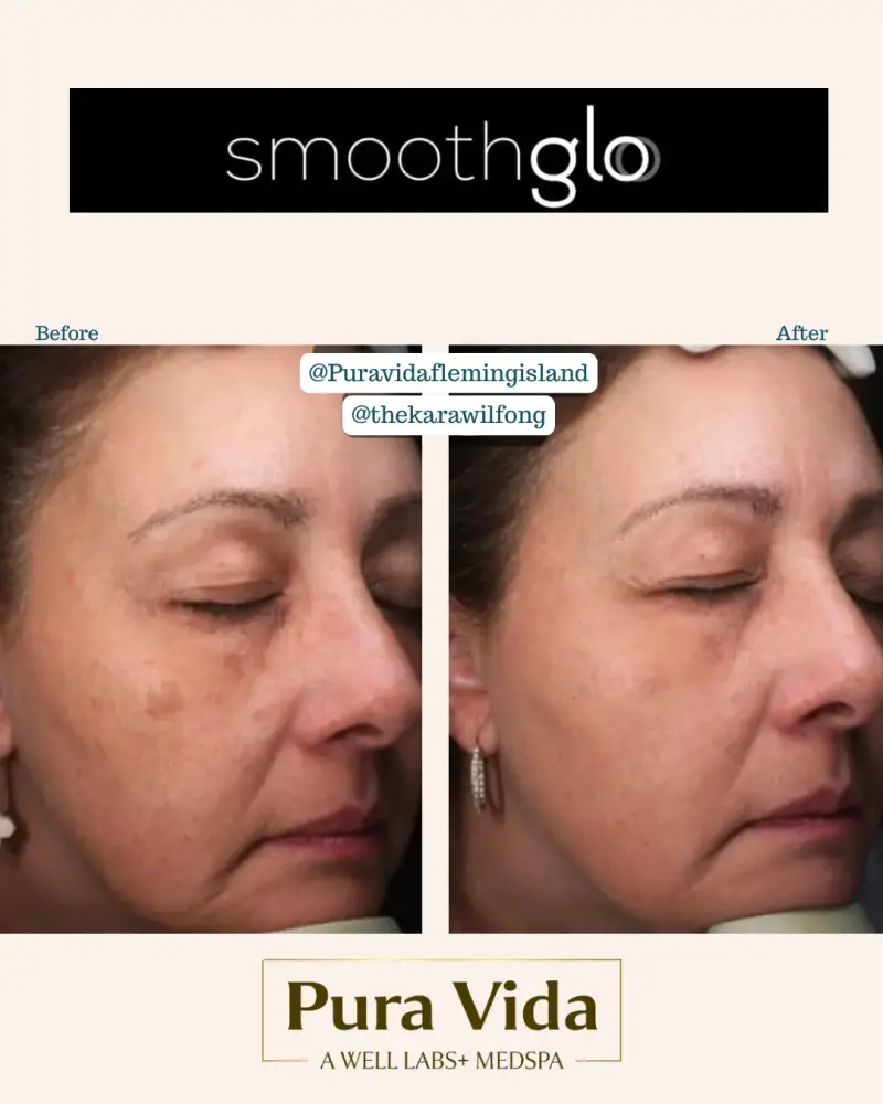 Before and after SmoothGlo showing reduced pigment patches across the cheek