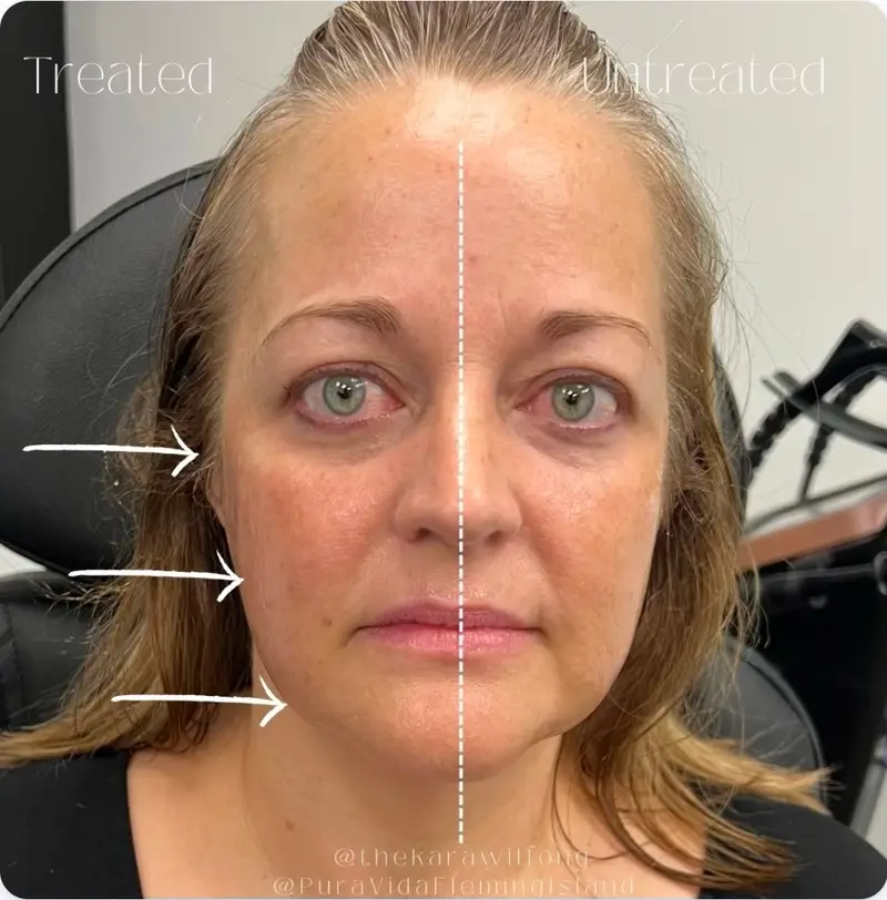 Before and after TriLift showing a lifted, tighter facial contour