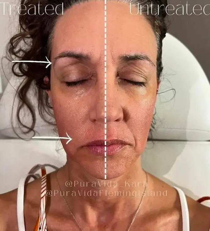 Before and after TriLift firming the jawline and cheeks