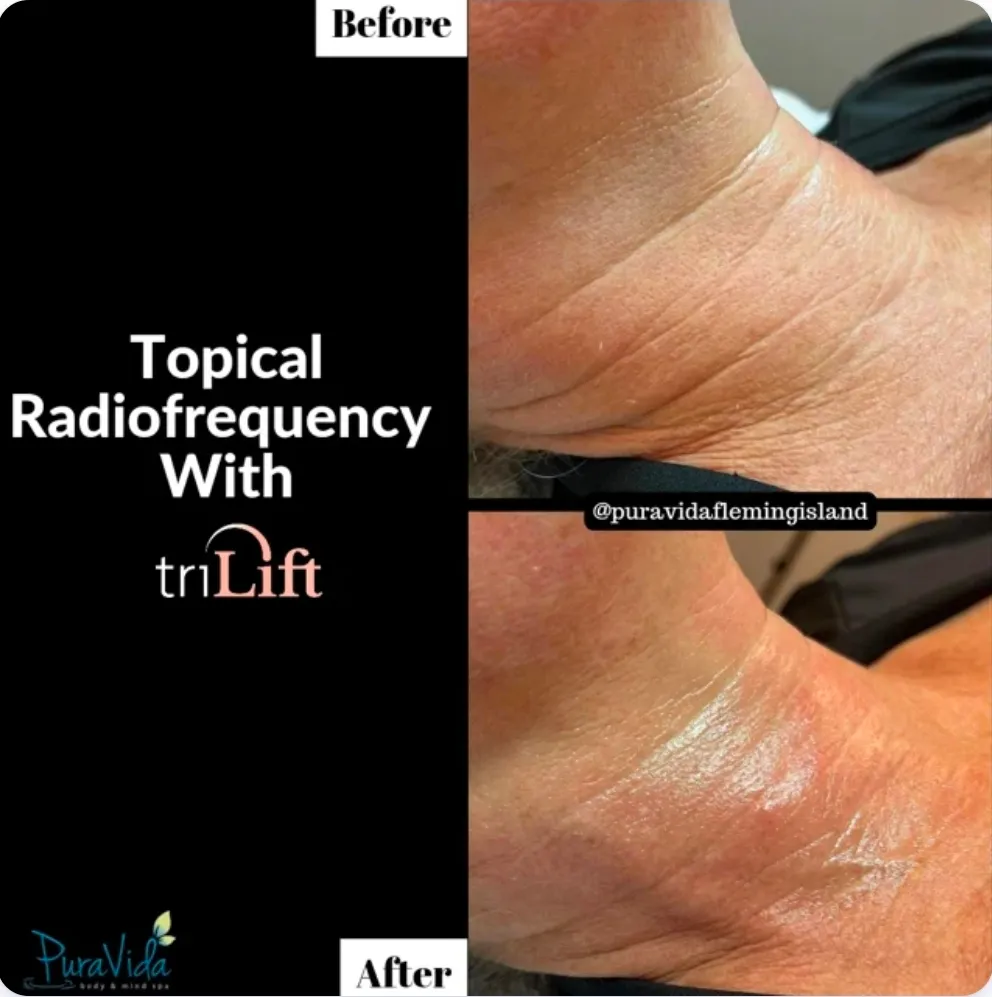 Before and after TriLift for smoother, more toned skin on the neck