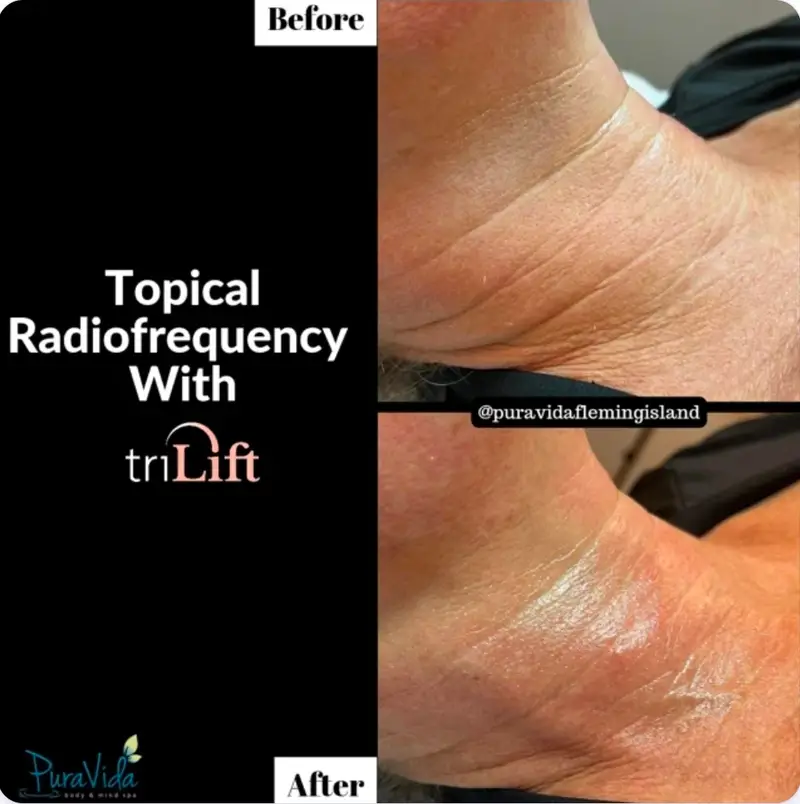 Before and after TriLift for smoother, more toned skin on the neck