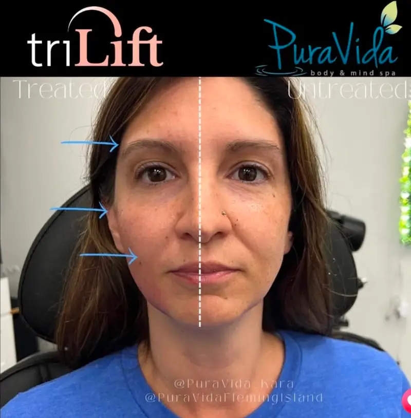 Before and after TriLift lifting the mid and lower face
