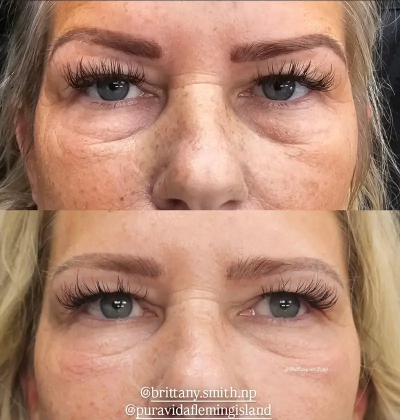 Before and after under-eye rejuvenation reducing hollows and dark circles