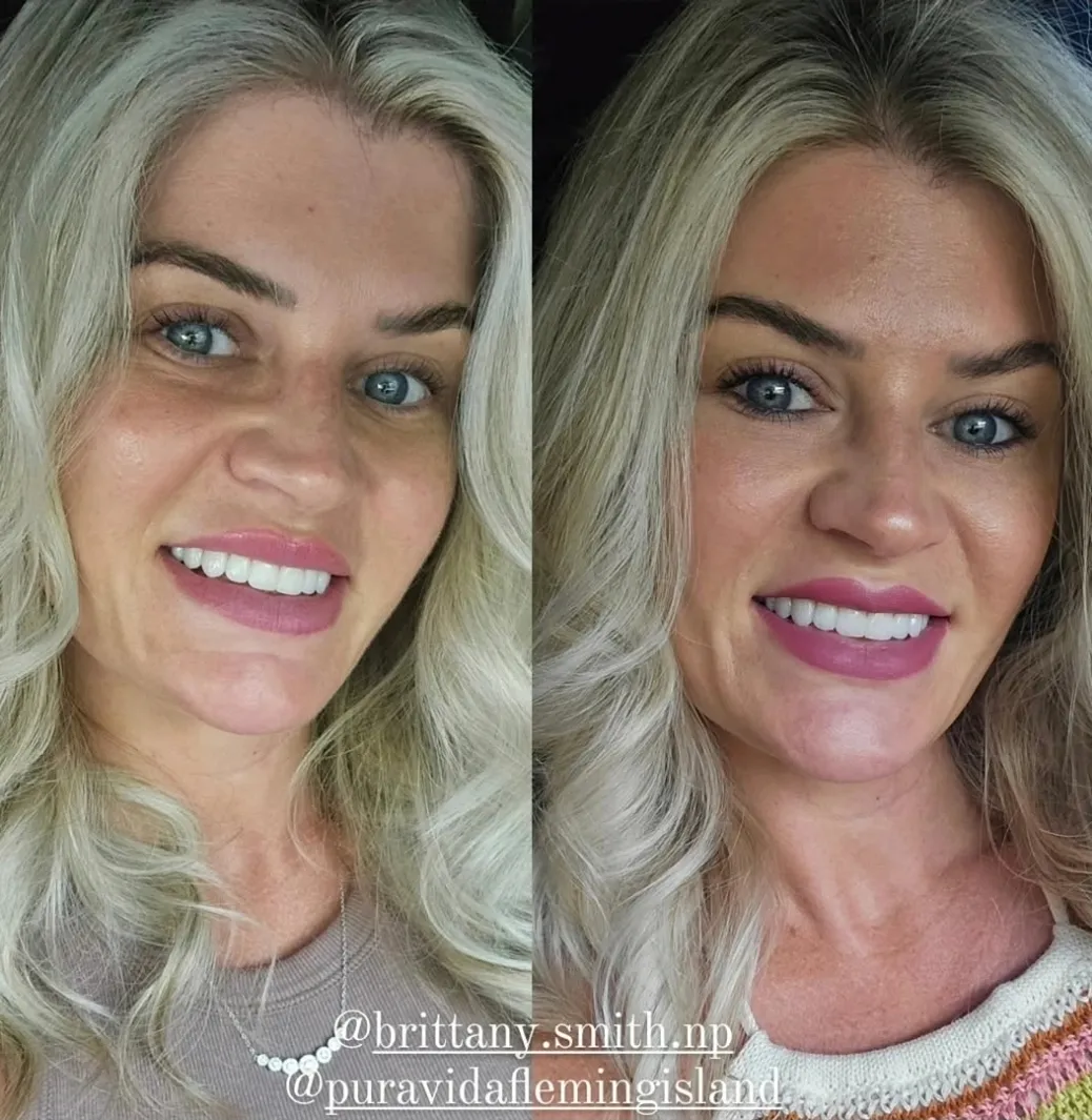 Before and after under-eye rejuvenation improving under-eye texture