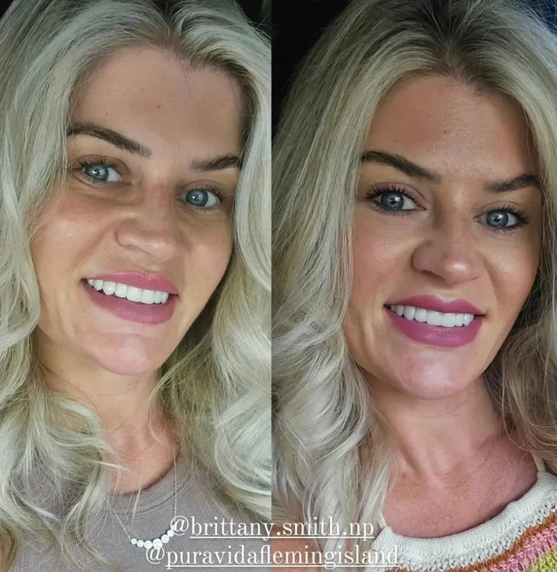 Before and after under-eye rejuvenation improving under-eye texture