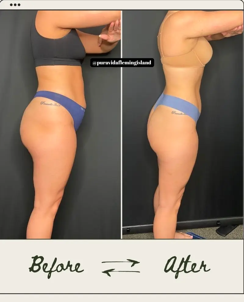 Before and after medical weight loss showing full-body progress